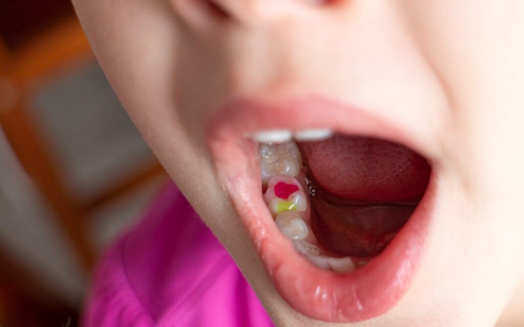 Dental Fillings That Are Great For Kids - Kids World Pediatric Dentistry