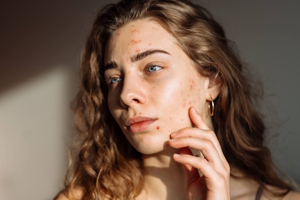 Young Woman with a problem skin