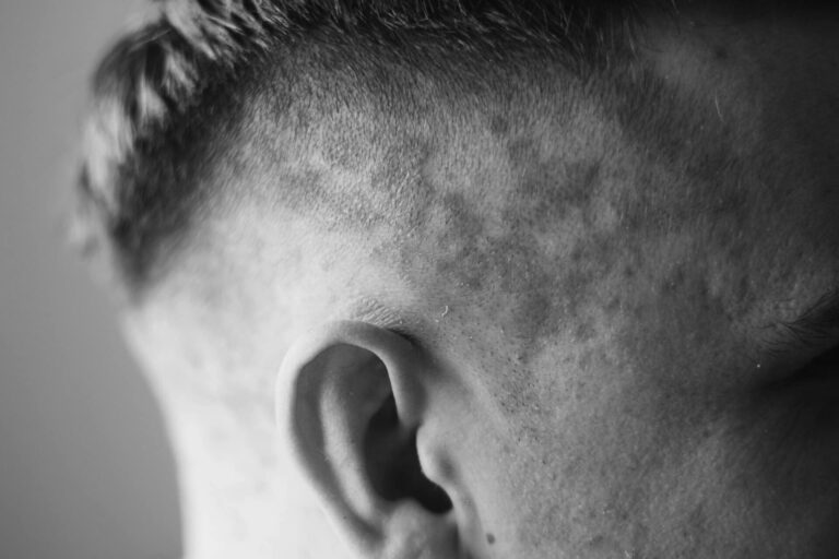 Psoriasis on the skin close-up
