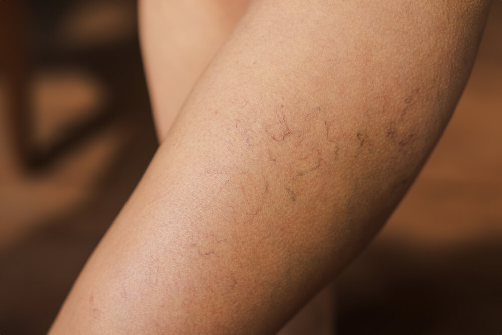 Varicose veins