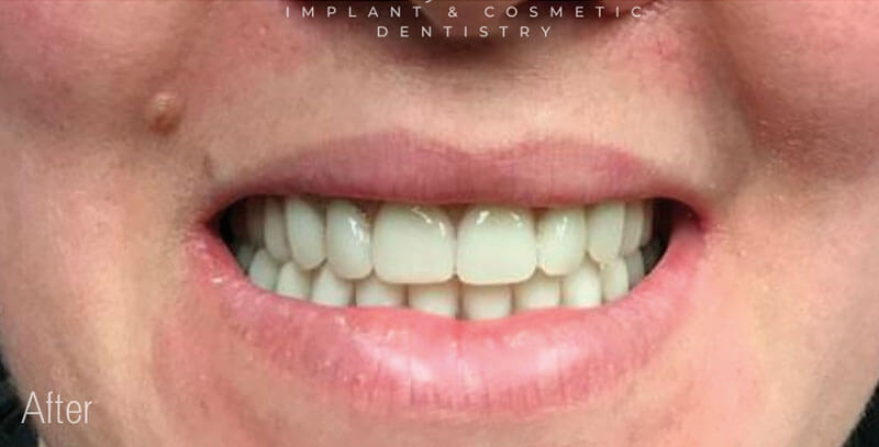 Same Day Dental Implants treatment