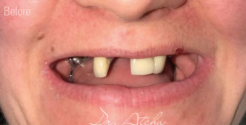 Same Day Implant Before treatment