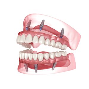 Full Mouth Reconstruction