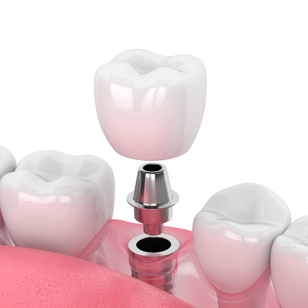 Single Dental Implant