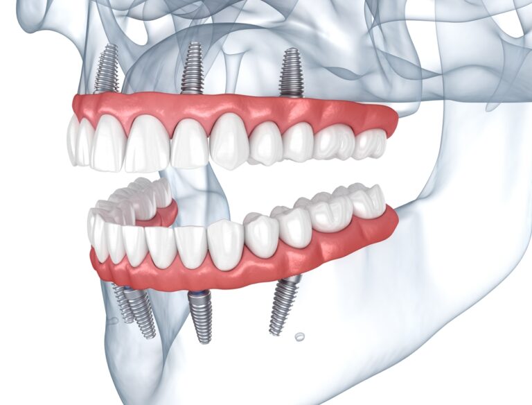 Prostheses Supported By 8 Implants