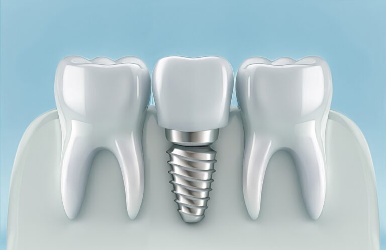 Dental Implants