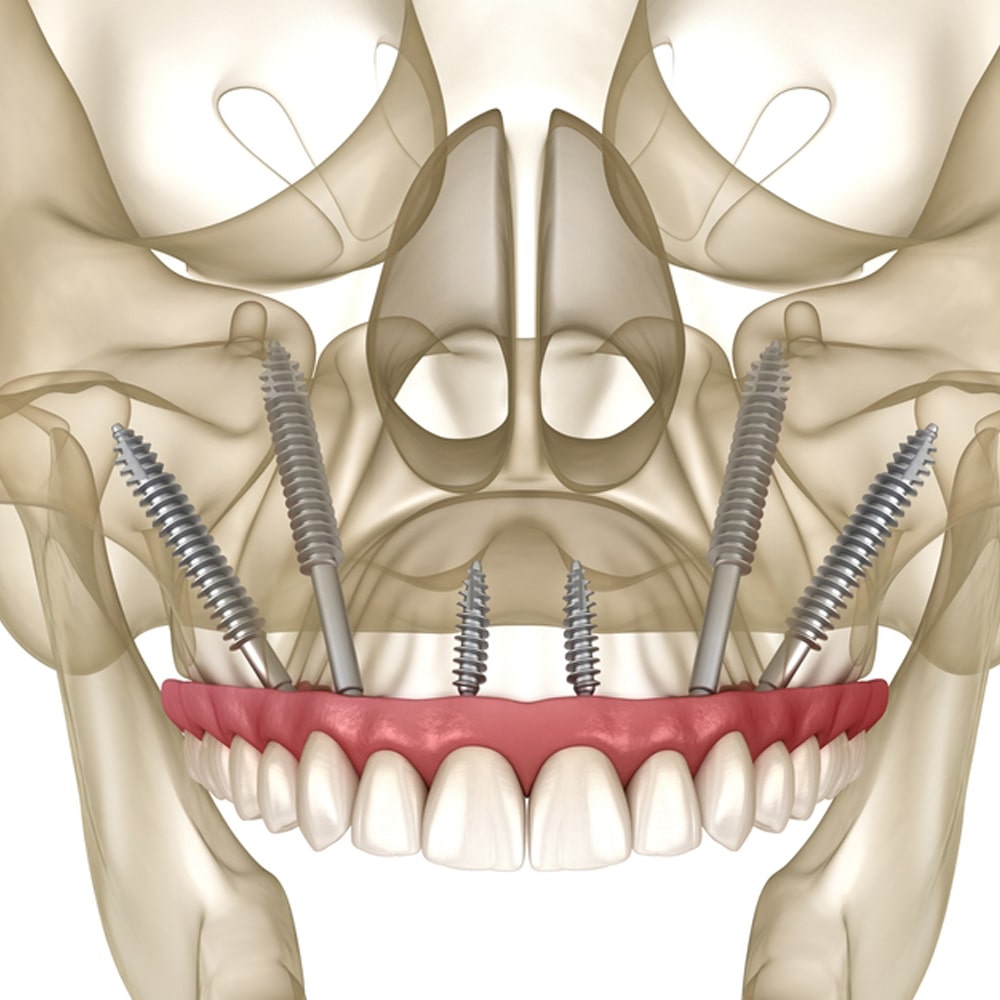 zygomatic