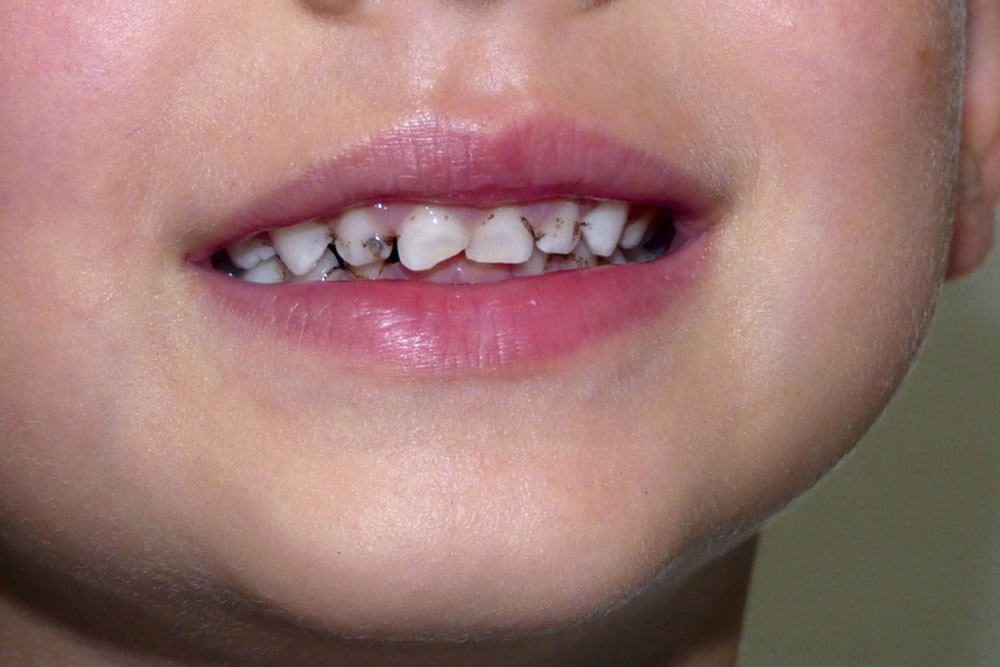 Close up of young boy's mouth showing decay in teeth