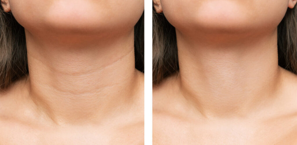 Before & After treatment image