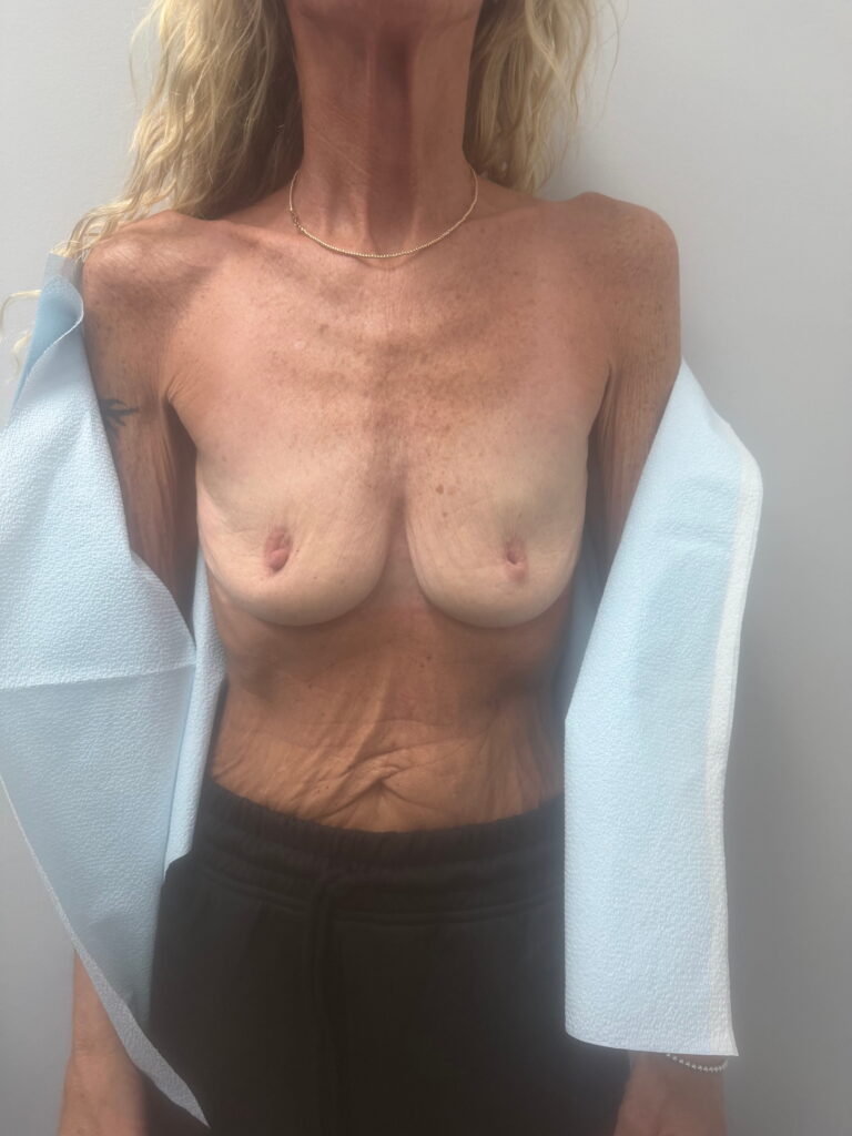 Breast before