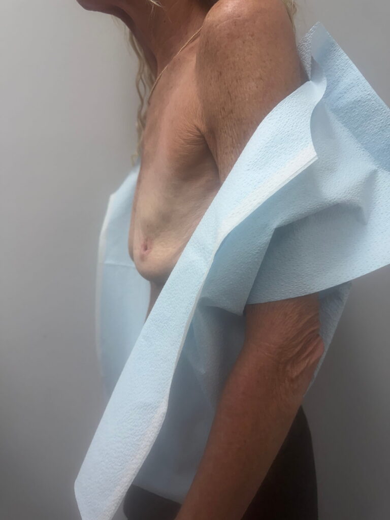 Breast before