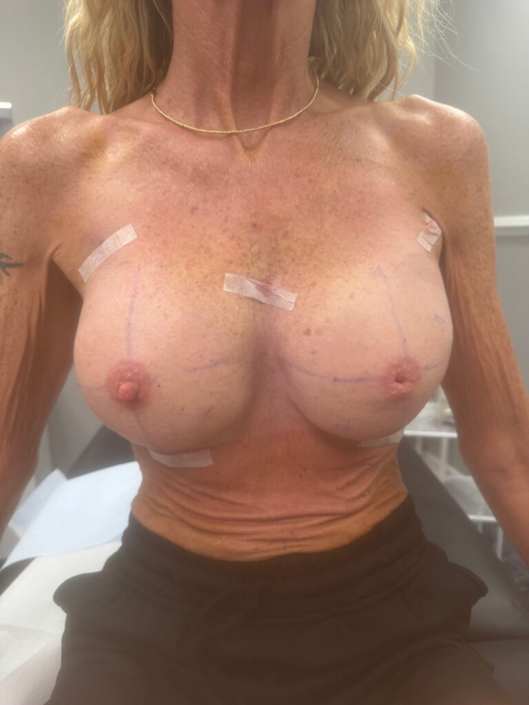 Breast after