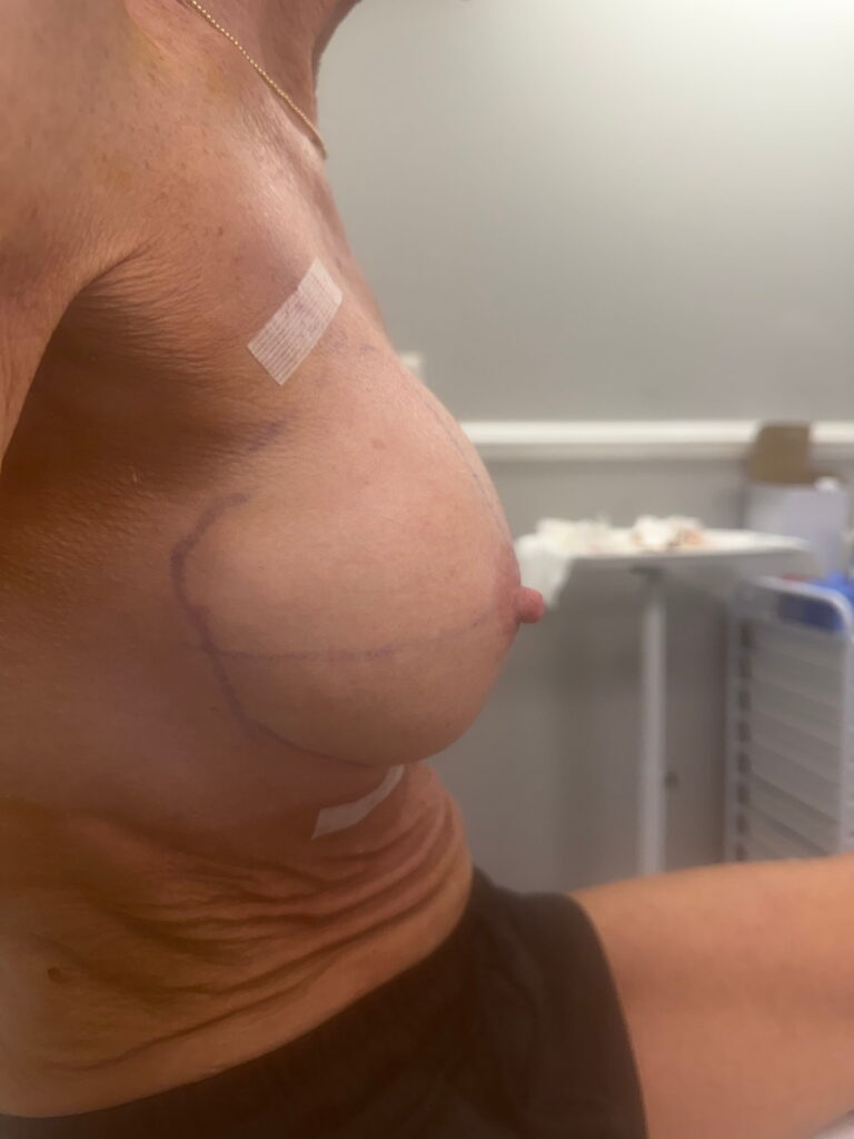 Breast after