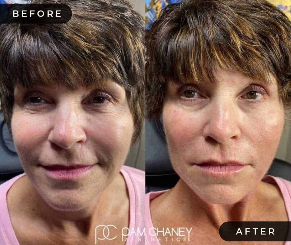 Botox Before and After