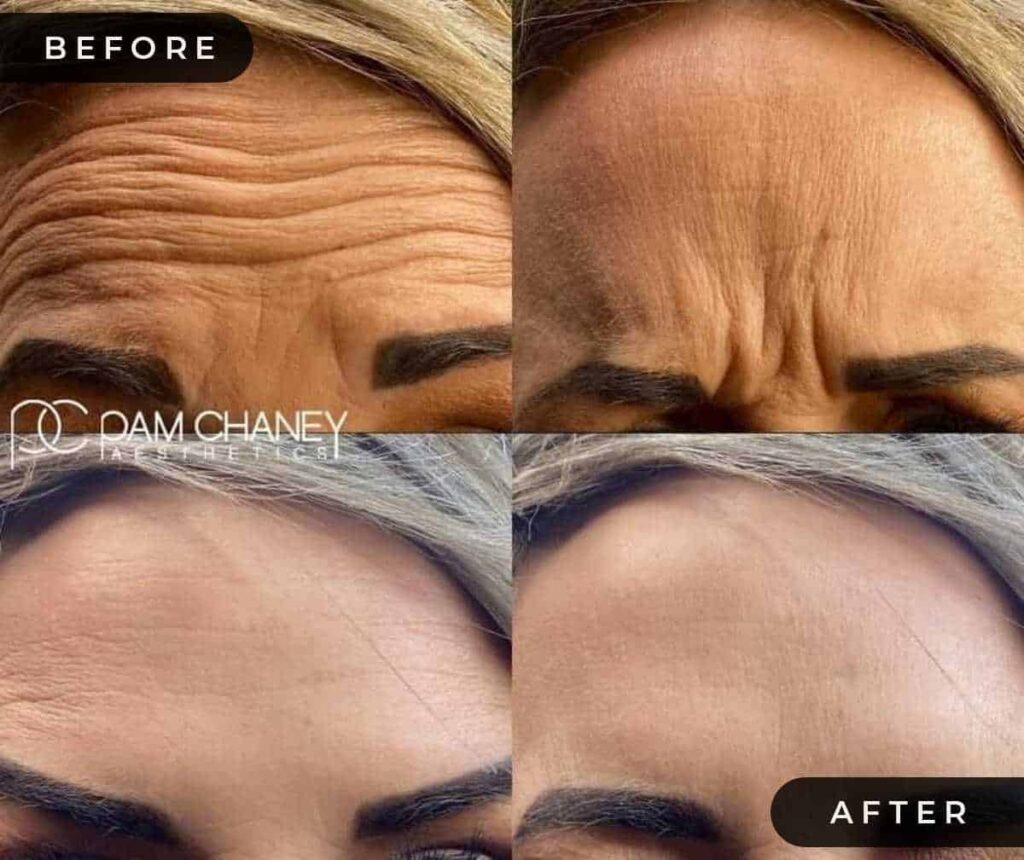 Botox Before and After