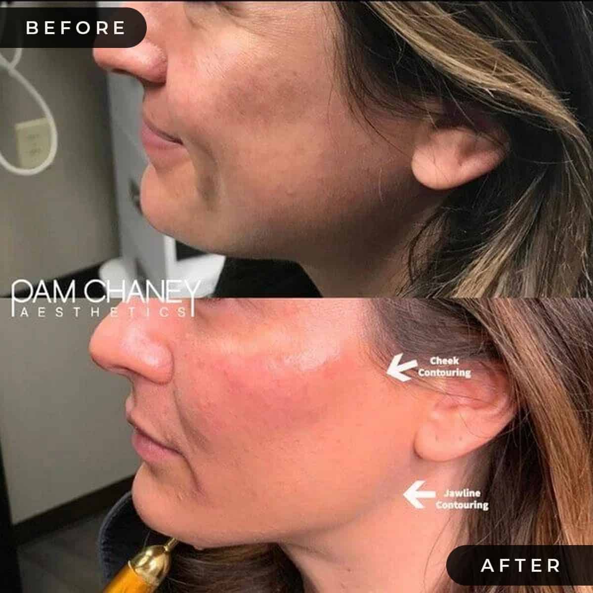 Cheek and Jaw line Contouring Before and After