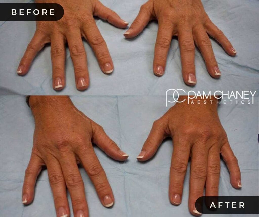 Hand Filler Before and After