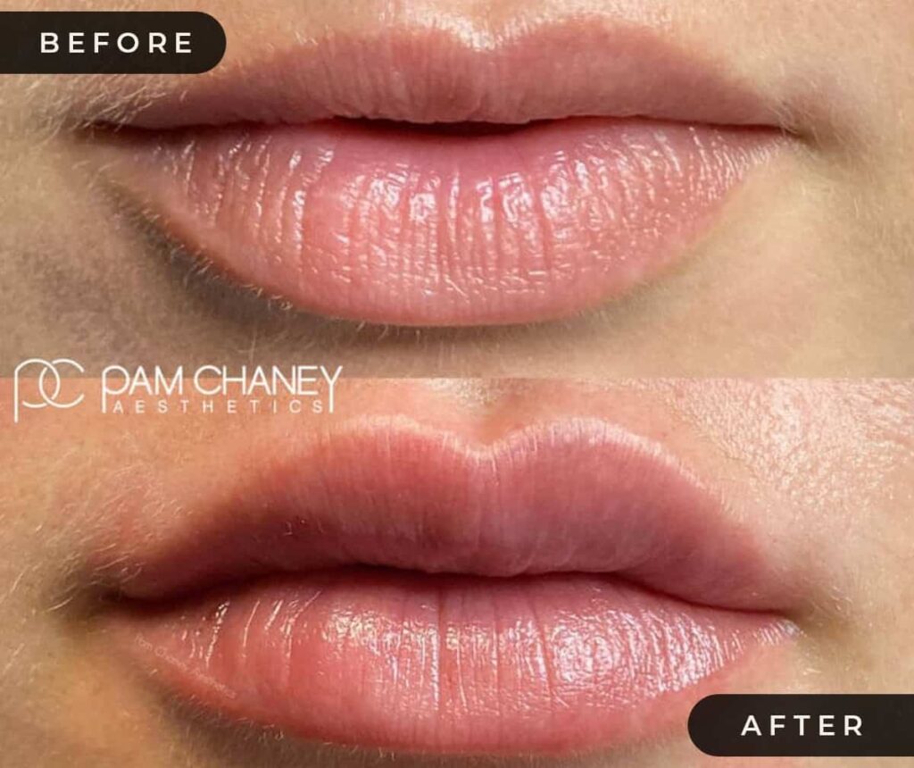 Lip Filler Before and After