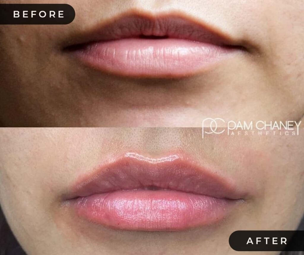 Lip Filler Before and After