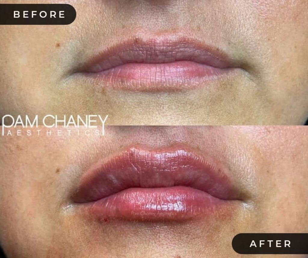 Lip Filler Before and After