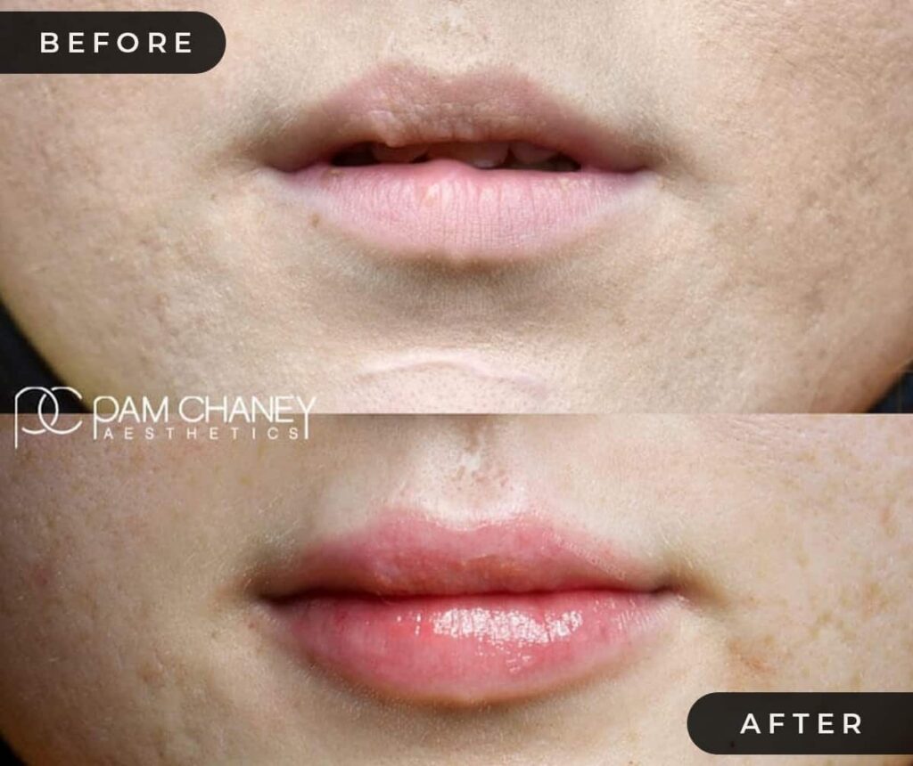 Lip Filler Before and After