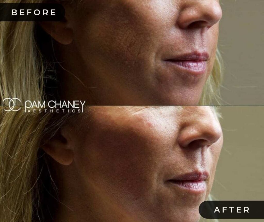 Lower face UnderAround Mouth Filler Before and After