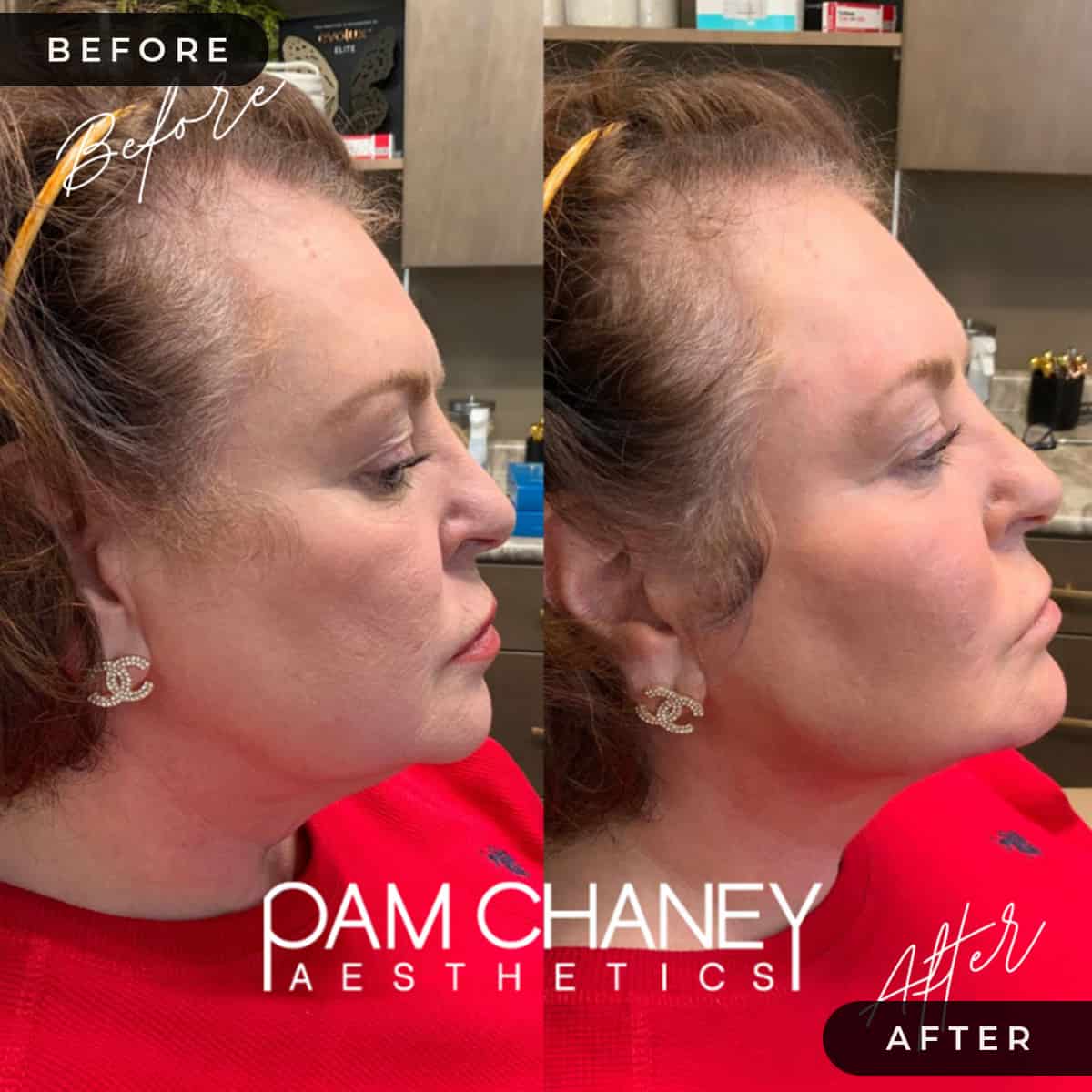 Mini Face Lift Before and After