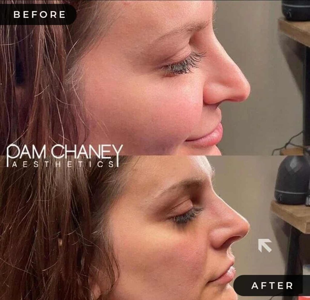 Non surgical rhinoplasty with Pdo threads Before and After