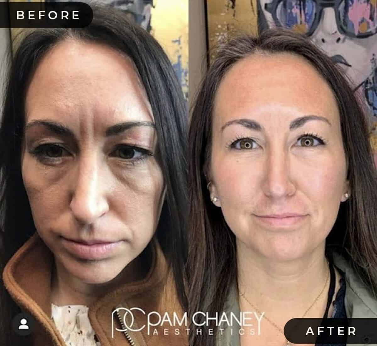 Before and After treatment